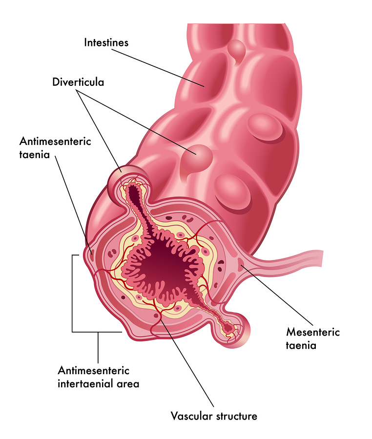 Divertikuloosi Tervevatsa